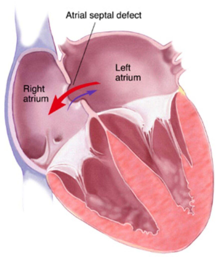 Atrial septal defect (ASD)