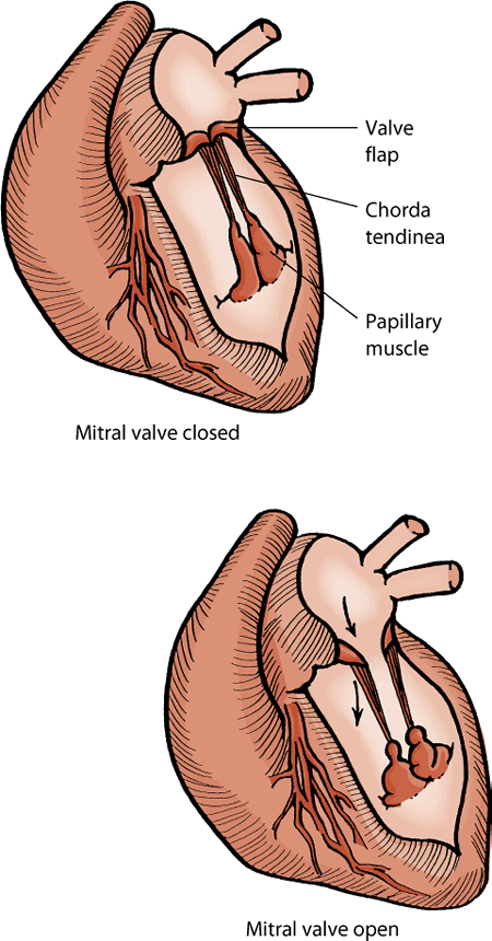 Mitral valve dysplasia