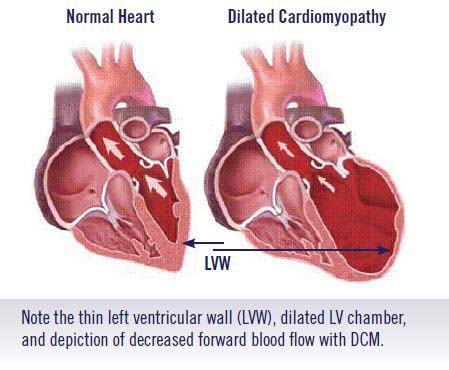 Dilated Cardiomyopathy DCM